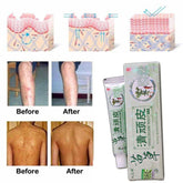 Health psoriasis treatment cream Skin care Dermatitis Eczematoid Eczema Ointment eczema cream psoriasis Itching relief Ointment