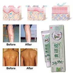 Health psoriasis treatment cream Skin care Dermatitis Eczematoid Eczema Ointment eczema cream psoriasis Itching relief Ointment