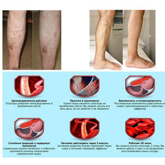 Varicose Veins ointment eins Varicose Treatment Plaster Varicose Veins Cure Patch Vasculitis Natural Solution Herbal Patches