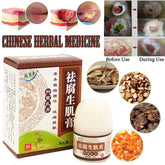 1PC Herbal Removal Rot Myogenic Cream Bedsores Paste Treat Pressure Sores/Decubituses/Pressure Ulcer Festering Wound Healing
