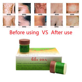 1pc Psoriasis Eczma Cream Works Perfect For All Kinds Of Skin Problems Patch Body Massage Ointment Chinese Medicine