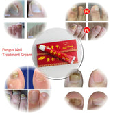 Chinese Medicine Plaster Nail Fungus Treatment Cream Onychomycosis Anti Fungal Nail Infection Fights Bacteria Naturally ointment