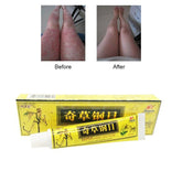 1pc Skin Psoriasis Cream Dermatitis Eczematoid Eczema Ointment Treatment Psoriasis Cream Skin Care Cream medical plaster
