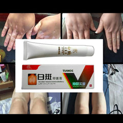 30g Chinese Medical White Spot Disease Cream Pigment Vitiligo Leukoplakia Disease Treatment Melanin Promoting Liniment Skin