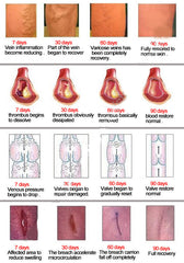 Varicose Veins ointment eins Varicose Treatment Plaster Varicose Veins Cure Patch Vasculitis Natural Solution Herbal Patches