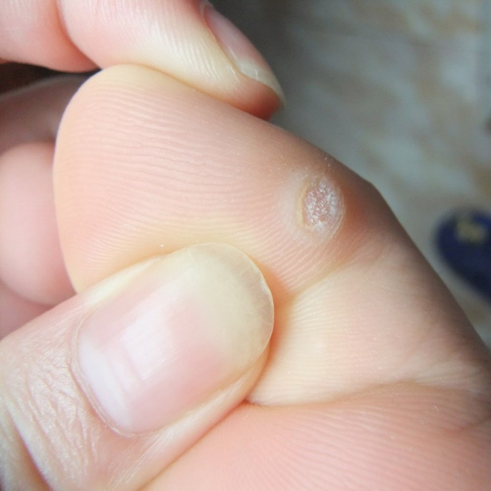 Detox Foot Pads Patches Feet Care Medical Plaster Foot Corn Removal Remover 12/24/36 pcs