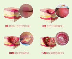 1PC Herbal Removal Rot Myogenic Cream Bedsores Paste Treat Pressure Sores/Decubituses/Pressure Ulcer Festering Wound Healing