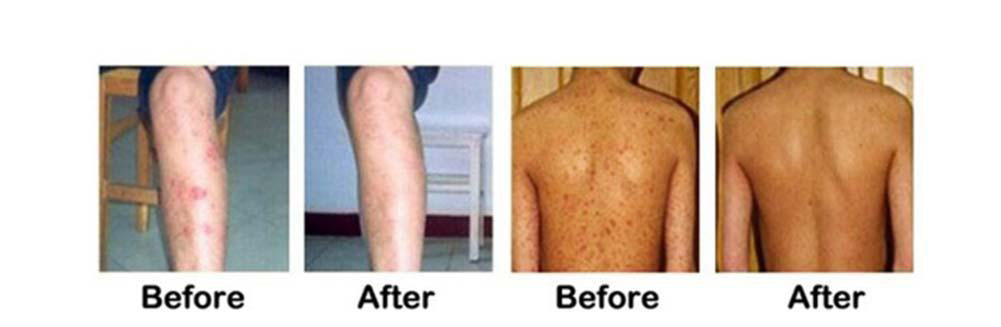 New Body Psoriasis Cream For Dermatitis and Eczema Pruritus Psoriasis Ointment Herbal Creams Skin Care Health Patches