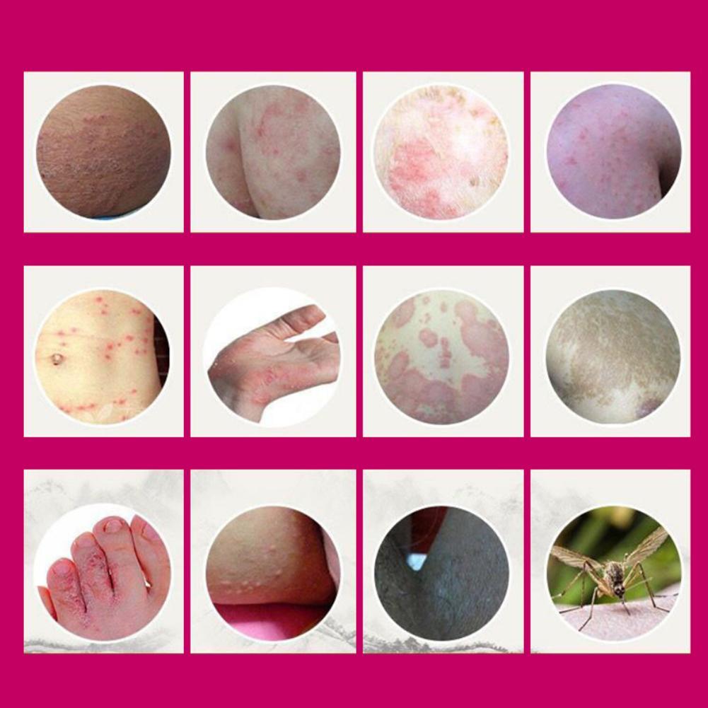Medical psoriasis Cream Dermatitis Eczema Hand Foot and Ringworm Tinea versicolor  Hemorrhoids Treatment Ointment Health Care