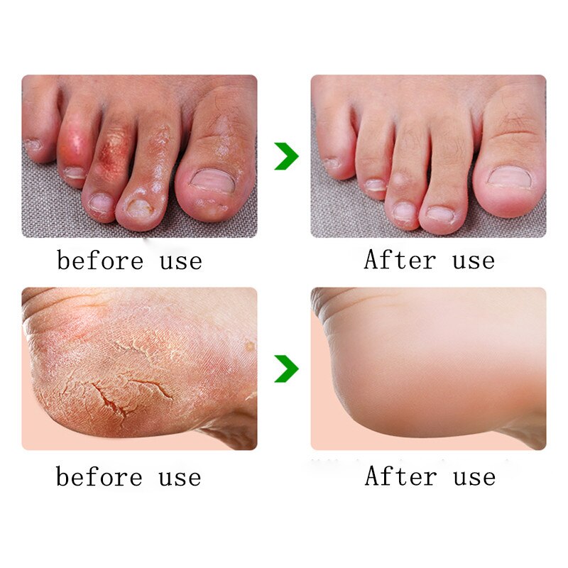 Horse Oil Foot Hand Antifreeze Cream Treatment Dry Skin Heel Chapped Peeling Repair Anti Chapping Wrinkle Treatment Ointment
